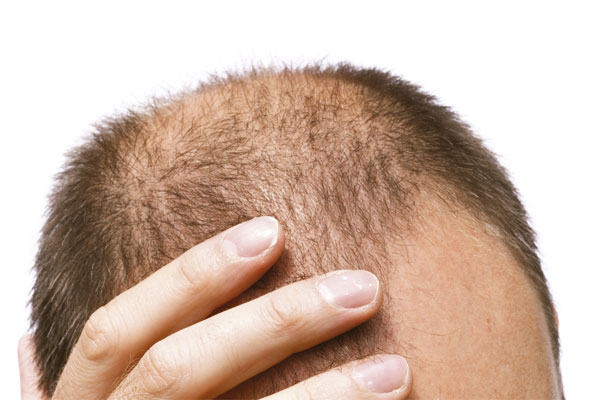 Calvicie O Que E E Como Tratar