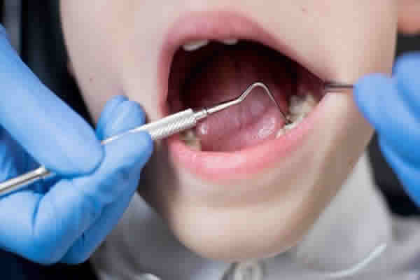 Dente Cariado Cuide Com Um Plano Odontologico